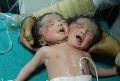Sinh con 2 đầu vì không có tiền siêu âm